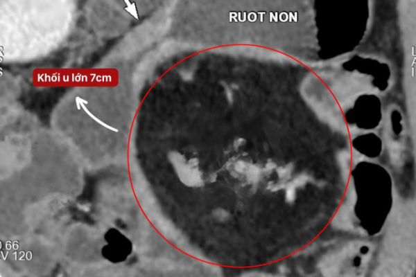 U mạc treo ruột non gây tắc ruột tái phát: Nguyên nhân và điều trị