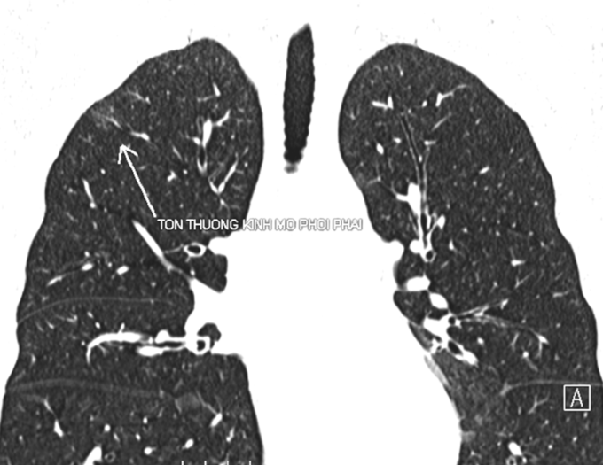 Ảnh chụp CT cho thấy các nốt tổn thương kính mờ trên phổi ông Duy. Ảnh: Bệnh viện Đa khoa Tâm Anh