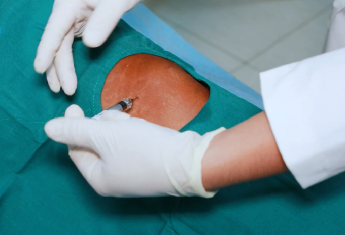 Bác sĩ thực hiện tiêm khớp cho người bệnh. Ảnh: Bệnh viện cung cấp
