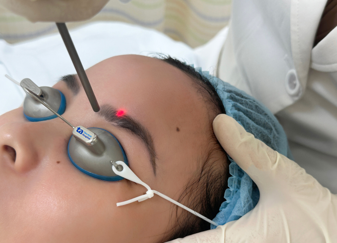 Bác sĩ xóa xăm chân mày cho khách hàng bằng công nghệ laser pico. Ảnh minh họa: Bệnh viện Đa khoa Tâm Anh