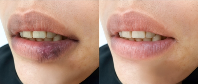 Lupus ban đỏ dạng đĩa trên môi của anh Cường được điều trị khỏi hoàn toàn. Ảnh: Bệnh viện Đa khoa Tâm Anh