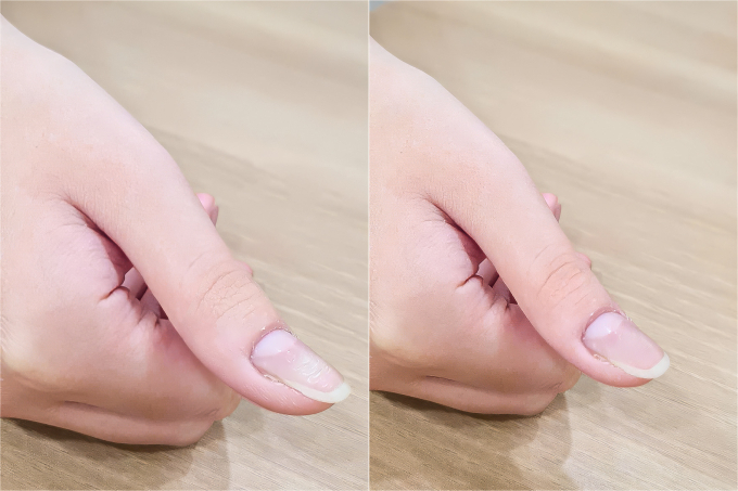Phần u cuộn mạch của Tâm trước (trái) và sau khi được loại bỏ hoàn toàn bằng laser công nghệ cao. Ảnh: Bệnh viện Đa khoa Tâm Anh