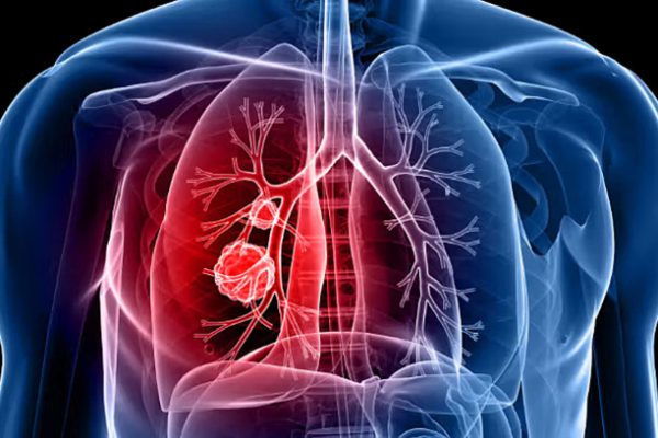FDA phê duyệt thuốc ‘tên lửa’ mới điều trị ung thư phổi