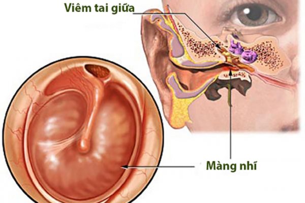 Bào tử lợi khuẩn dạng xịt: Giải pháp cho sức khỏe hô hấp