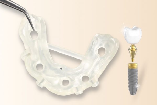 Trồng răng implant an toàn với máng định vị tại Nha khoa Kim