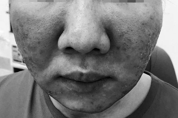 Da cháy xém sau dùng kem ‘siêu chống nắng’