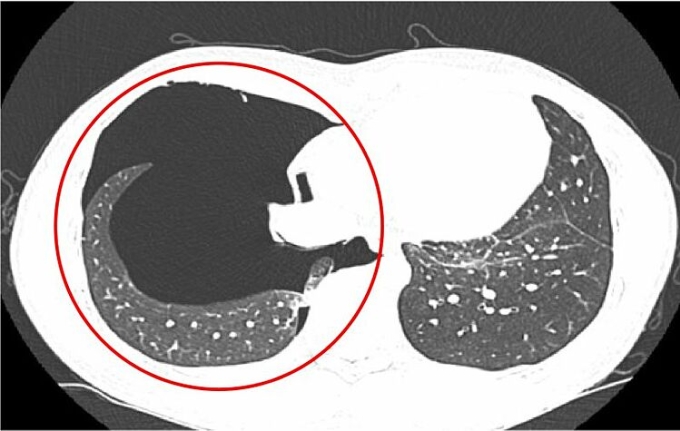 Hình ảnh chụp CT cho thấy tràn khí khoang màng phổi phải mức độ vừa đến nhiều. Ảnh: Bệnh viện cung cấp