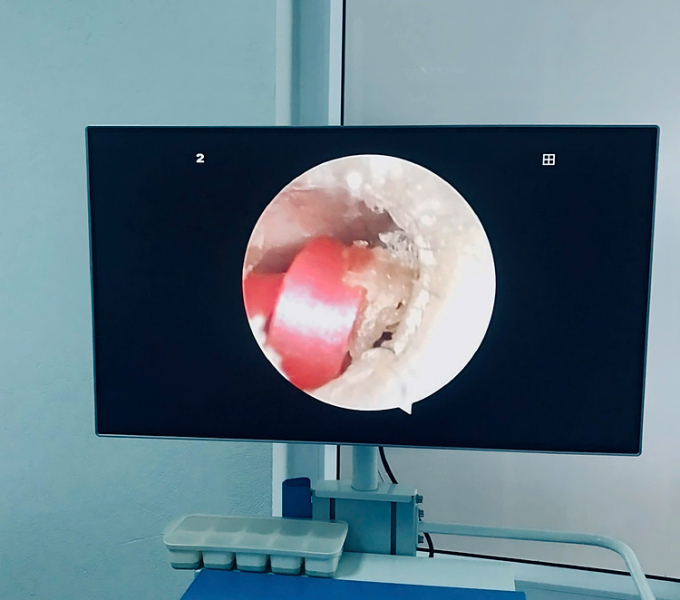 Sợi dây buộc tóc cao su nằm sâu trong ống tai bệnh nhi. Ảnh: Bệnh viện cung cấp
