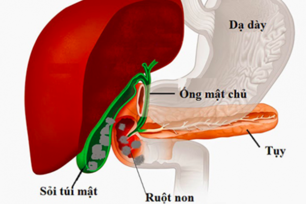 Sỏi mật: Hiểm họa tiềm ẩn và biến chứng nguy hiểm