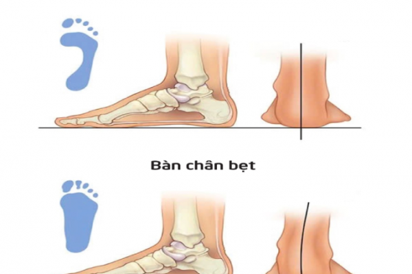 Nhận biết sớm bàn chân bẹt ở trẻ: Dấu hiệu và cách kiểm tra