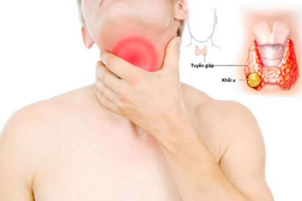 Ung thư tuyến giáp: Ai có nguy cơ mắc bệnh?
