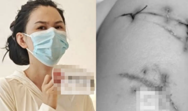 Túi độn ngực cứu sống một phụ nữ: Tin tức sốc