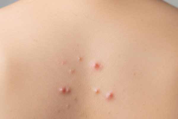 Bí quyết giảm mụn lưng hiệu quả