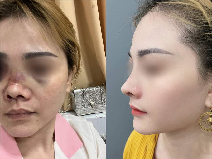 Hình ảnh trước sau một ca sửa mũi phức tạp tại Nam An, từ cánh mũi bị cắt hỏng đến dáng mũi hài hòa, tự nhiên. Ảnh: Nam An