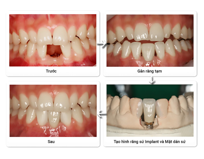 Quá trình phục hình răng implant tại Thanh Hằng Beauty Medi. Ảnh: Thanh Hằng Beauty Medi