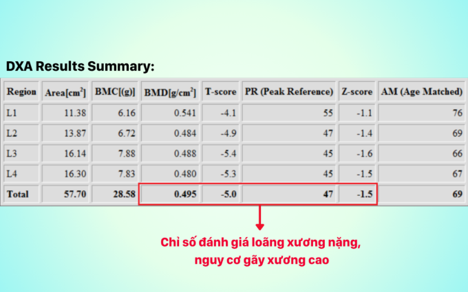 Kết quả đo loãng xương phát hiện loãng xương nặng. Ảnh: Bệnh viện Đa khoa Hồng Ngọc