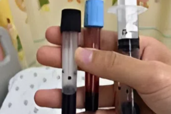 Ngộ độc Methemoglobin: Máu bé gái chuyển màu nâu đen sau bữa ăn