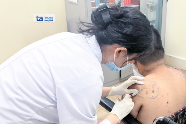 Sẹo lồi do mụn: Nguyên nhân và cách điều trị hiệu quả