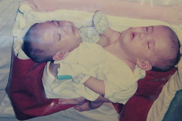 Ước nguyện của bác sĩ mổ tách Song – Pha dính liền