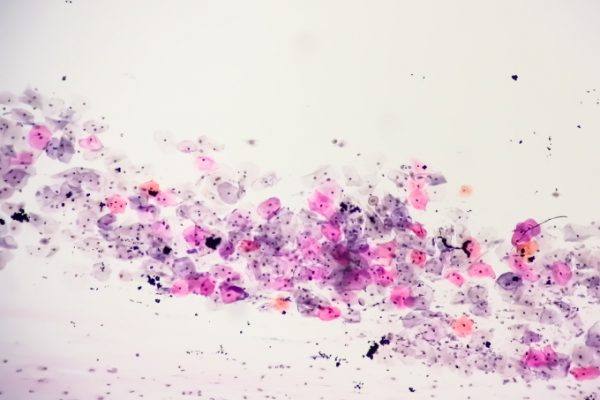 Ung thư khoang miệng: Hai loại virus nguy hiểm cần biết