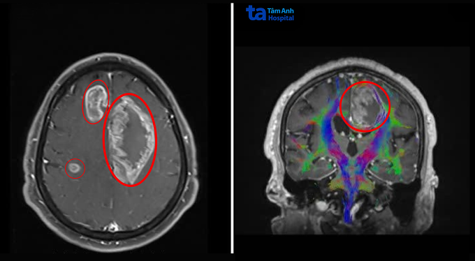Ảnh chụp MRI 3 Tesla ghi nhận ba khối u lớn (khoanh tròn) trong não ông Giang. Ảnh: Bệnh viện Đa khoa Tâm Anh
