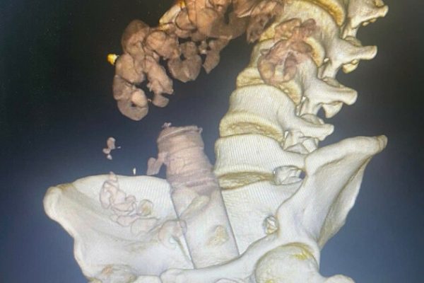 Cảnh báo: Dị vật đồ chơi tình dục mắc kẹt ở hậu môn