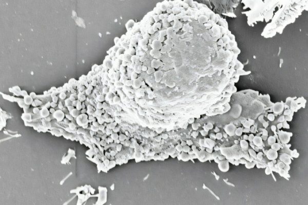 Vaccine cá nhân hóa: Chặn đứng tái phát ung thư hiệu quả