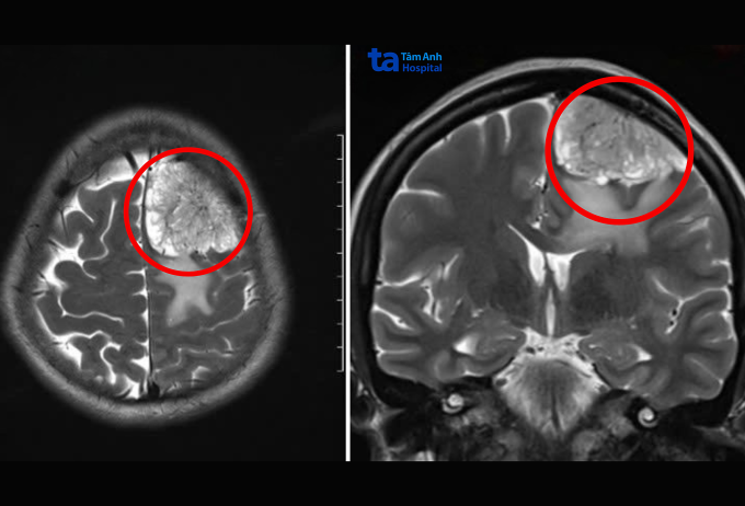Chụp MRI cho thấy khối u màng não của chị Xuân gây chèn ép và phù nhu mô não. Ảnh: Bệnh viện Đa khoa Tâm Anh