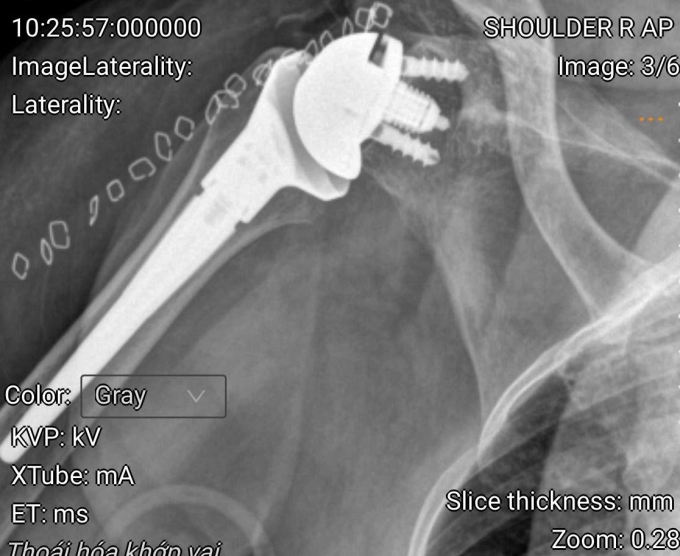 Khớp vai nhân tạo của bà Kiều sau khi thay. Ảnh: Bệnh viện Đa khoa Tâm Anh