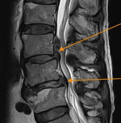 Thay đĩa đệm nhân tạo: Giải pháp cho thoát vị đĩa đệm lưng