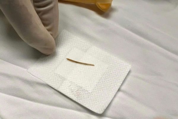 Cảnh báo: Bé 2 tuổi bị xương cá đâm thủng ruột