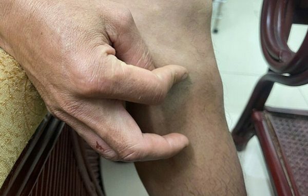 Giun rồng 70cm: Ký sinh trùng ẩn dưới da người