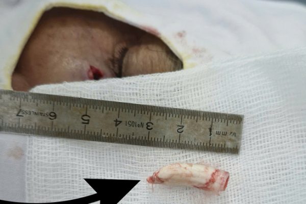 Cựa gà 2.8cm đâm vào mặt người: Tai nạn hy hữu