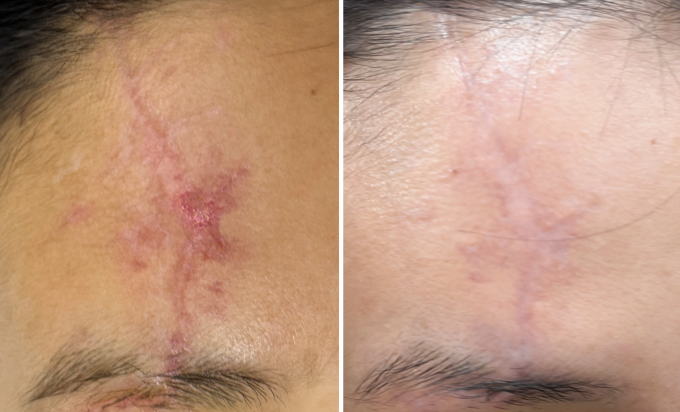 Vết sẹo của chị Minh mờ đáng kể sau hai lần điều trị bằng laser 4D. Ảnh: Bệnh viện Đa khoa Tâm Anh