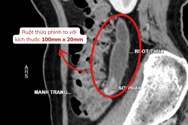 Sụt cân không rõ nguyên nhân: Phát hiện bệnh ruột thừa hiếm gặp