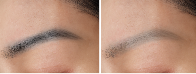 Chân mày trước (bên trái) và sau một lần xóa bằng laser pico của chị Mai (bên phải). Ảnh: Phòng khám Đa khoa Tâm Anh Quận 7