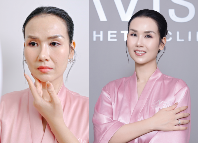 Võ Hạ Trâm trước và sau liệu trình trẻ hóa: đẩy lùi nếp nhăn, da săn, sáng hồng hơn trước. Ảnh: Lavish Clinic By Huyen Baby