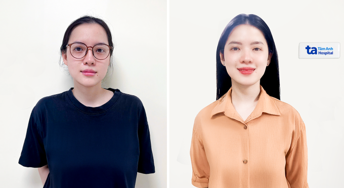 Chị Thảo trước và sau mổ cận. Ảnh: Bệnh viện Đa khoa Tâm Anh