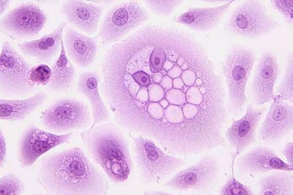 Điều trị ung thư da hiệu quả bằng virus Herpes