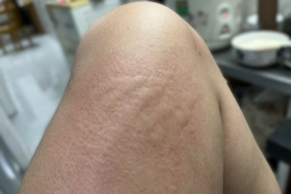 Dị ứng côn trùng đốt: Khi nào nên tiêm vaccine?