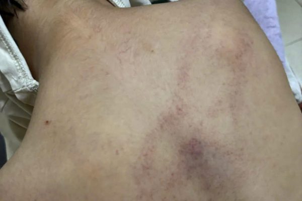 Bé 4 tuổi bị đánh tím lưng ở lớp: Bạo hành trẻ em?