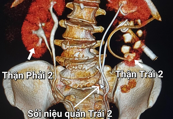 Hiếm gặp: Người phụ nữ có 4 quả thận