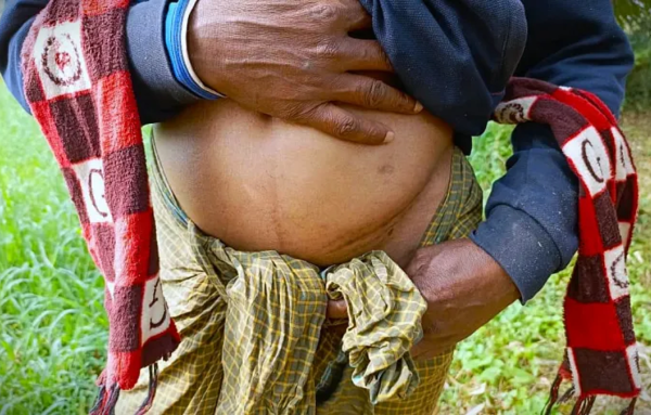 Ngôi làng một thận: Bi kịch ở Bangladesh
