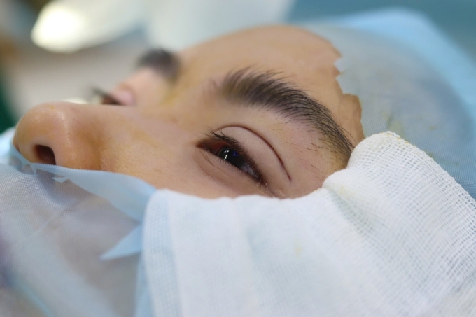 Nhấn mí tạo nếp mí rõ và tự nhiên, hài hòa với gương mặt. Ảnh: Dr. Ho Cao Vu