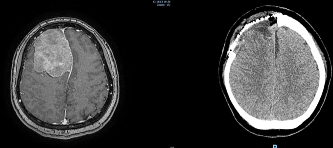 MRI trước phẫu thuật với khối u như trái cam chiếm 1/4 não (bên trái) và MRI sau phẫu thuật, đã xử lý xong khối u (bên phải). Ảnh: Bệnh viện cung cấp