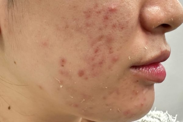 Mụn nội tiết và mụn trứng cá: Phân biệt và cách điều trị