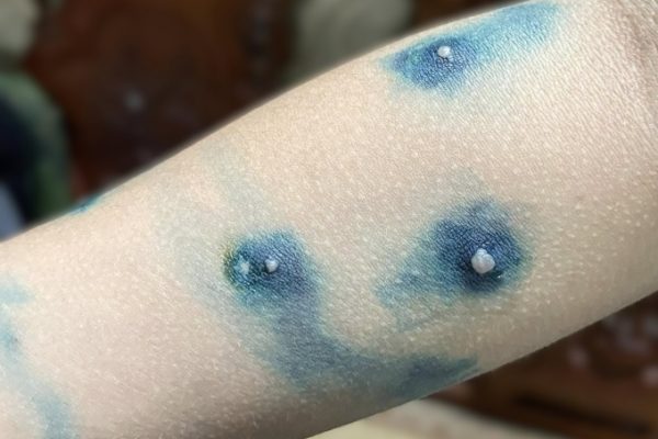 Cây nhọ nồi trị thủy đậu: Thực hư và lưu ý