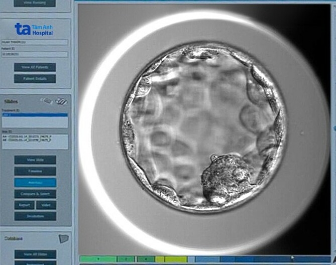 Phôi ngày 5 chất lượng tốt và không mang bất thường di truyền được nuôi cấy tại IVF Tâm Anh. Ảnh: Thu Thảo