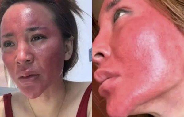 22 Năm Không Tẩy Trang: Biến Chứng Da Nghiêm Trọng