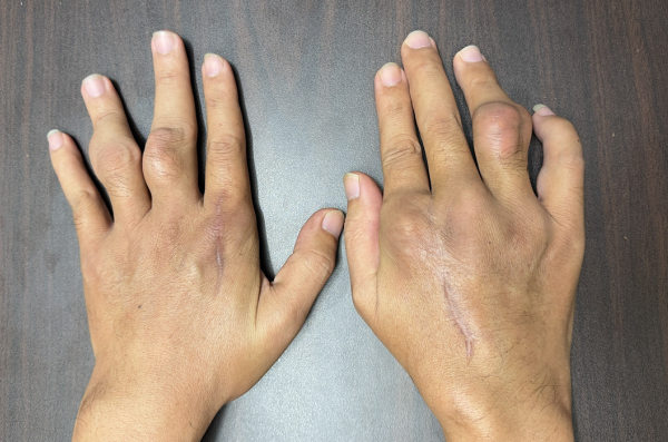 Gout ở tuổi đôi mươi: Sống chung và kiểm soát bệnh